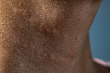 Fototapeta premium Woman's skin after subcutaneous injections to smooth out wrinkles.