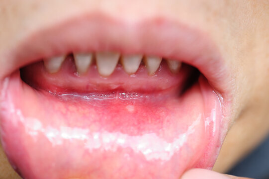 Showing red and painful canker sore inside lip