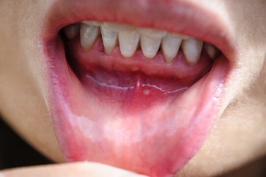 Showing mouth ulcer or canker sore or aphthous stomatitis or aphthous ulcer