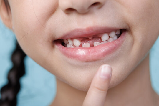 Asian child girl missing front loose tooth pointing, Dentistry and Health care concept, Empty space isolated on blue background
