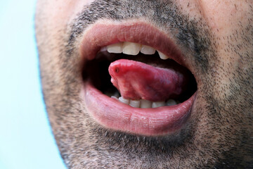 Asian man have aphthous ulcers on tongue