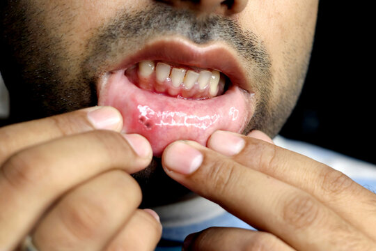 Asian man have aphthous ulcers on mouth