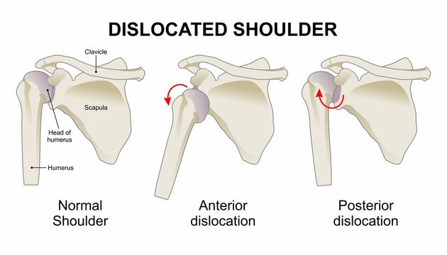 Dislocated shoulder and types of shoulder dislocation