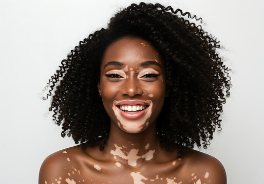 Smiling woman with vitiligo poses confidently against a white backdrop, showcasing natural beauty and selfacceptance in a portrait of empowerment.
