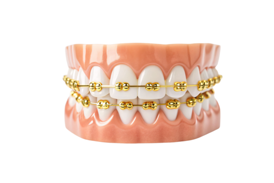 Dental model displaying green braces on both upper and lower tooth rows, isolated on a transparent background
