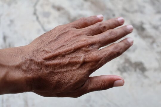 Prominent dorsal metacarpal veins in left hand of Asian man. 