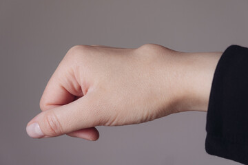 Female right back hand with ganglion cyst on the dorsum,  fluid-filled bump associated with a joint or tendon sheath, close-up view, selected focus.
