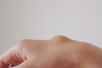 Female right back hand with ganglion cyst on the dorsum,  fluid-filled bump associated with a joint...