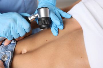 Doctor examining young woman's mole with dermatoscope in hospital, closeup