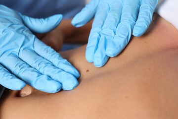 Doctor examining young woman's mole in hospital, closeup