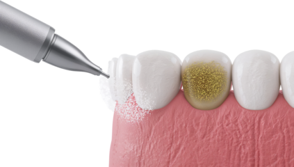 Dental cleaning treatment demonstrating professional removal of stains and plaque build up for