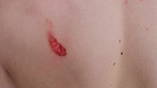Skin bruise with red and purple discoloration on the back during an outdoor activity in bright daylight