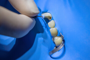 Dentist’s hands inserting a dental file into a tooth during root canal treatment with rubber dam...