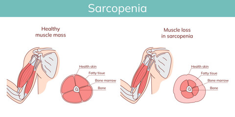 Sarcopenia. Loss of muscle mass.Vector anatomical illustration