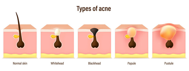 Types of acne skin vector. Blackheads, Whiteheads, Papules and Pustules. Facial skin problems. Vector for advertising about beauty and medical treatment.