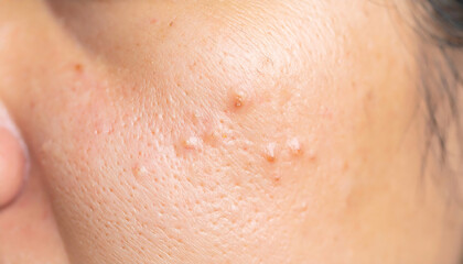 Fototapeta premium Close up of problematic skin with milia, whiteheads, and clogged pores, a common dermatology health concern.