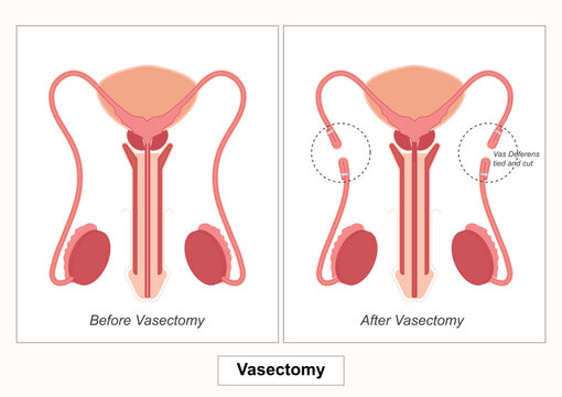 Vasectomy is a surgical procedure for permanent contraception in men involving cutting.