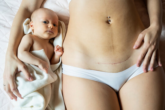 Mother with caesarean scar lying by baby boy on bed