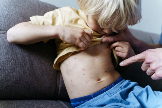Father pointing finger and examining chickenpox on son at home