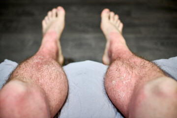 Close-up view of sunburned legs resting on soft surface, revealing desquamation. Soft lighting...