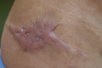 Keloid scar forming on patient's skin after surgery