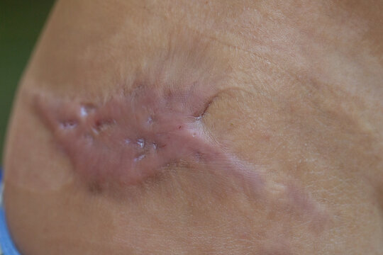 Keloid scar forming on patient's skin after surgery