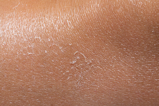 Close-up of dry and peeling skin showing severe dehydration