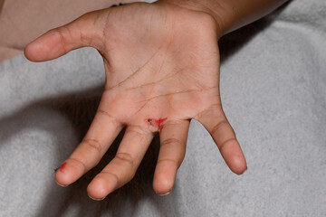 Child showing bleeding wound on hand and finger