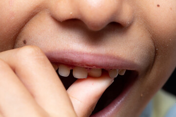 Child touching loose tooth with finger: close-up of mouth and nose