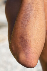 Large hematoma showing through skin on patient's arm near elbow