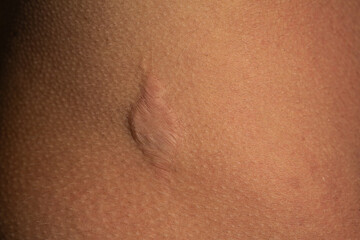 Large scar healing on skin after surgery or trauma