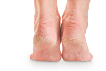 Female dry and cracked soles of feet isolated on white background with clipping path. Closeup of dry crack skin. Hygiene, human skin disease. Design element.