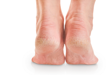 Female dry and cracked soles of feet isolated on white background with clipping path. Closeup of dry crack skin. Hygiene, human skin disease. Design element.