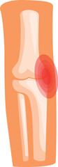 Medical illustration showing an elbow joint inflammation causing pain