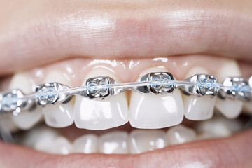 Teeth moving into alignment with invisible braces, teeth adjustment