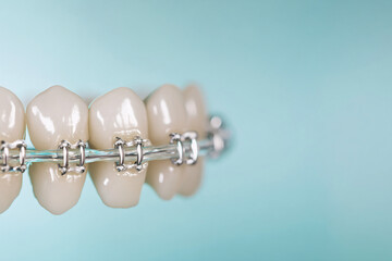 Teeth moving into alignment with invisible braces, teeth adjustment