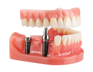 A 3D model of a dental implant on a jaw, showing a single crown replacing a missing tooth in the upper arch.