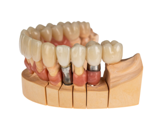 A 3D rendering of a dental implant placed in the lower jaw, with a detailed view of the titanium screw.