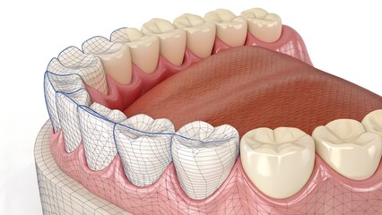 Upper jaw 3D model with wireframe overlay on teeth – Orthodontic planning, dental simulation, digital dentistry, oral anatomy visualization, treatment mapping, medical technology