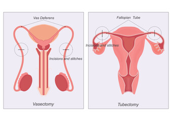 Sterilization is any of several medical methods of permanent birth control .