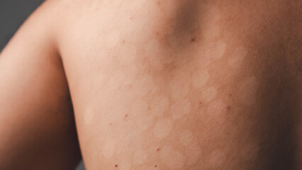 Skin fungus, ringworm, possibly caused by fungal infection or vitiligo. High-resolution medical or...