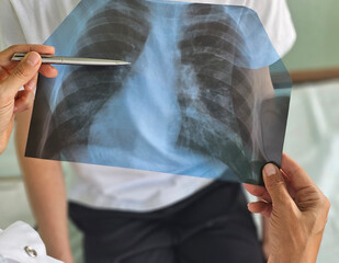 Doctor examining chest X-ray for patient diagnosis