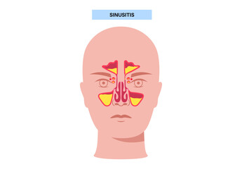 Sinusitis medical poster
