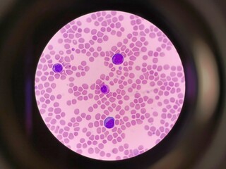 Microscopic view of blood pathology showing abnormal cells.  Medical Laboratory Research.