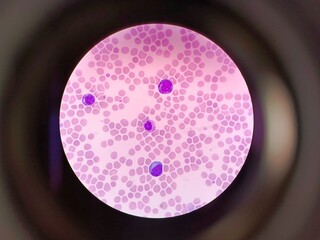 Microscopic view of blood pathology showing abnormal cells.  Medical Laboratory Research.