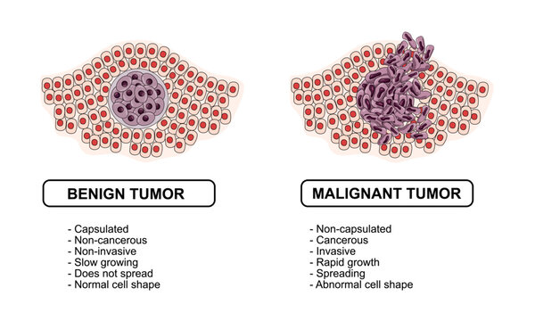 Vector illustration of malignant and benign tumors in body tissues. Difference between malignant and benign tumors, Spread of cancer cells. Medical vector illustration for education, posters, clinics,
