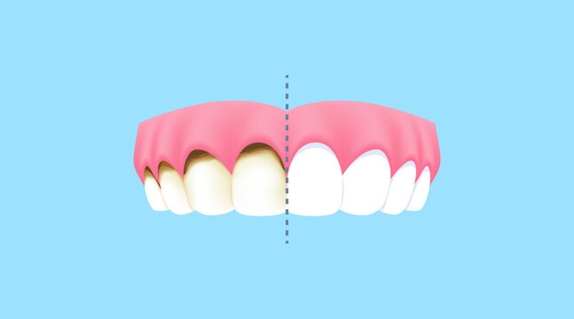 Upper teeth - Decay (Before and After Comparison) illustration vector design. Dental care concept.
