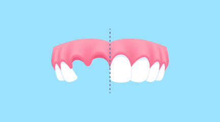 Upper teeth - Lost tooth (Before and After Comparison) illustration vector design. Dental care concept.
