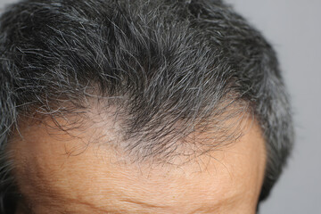 Fototapeta premium Thinning Hair and Gray Hair on Male Scalp. Concept of Hair Loss, Growth Treatment, and AGA Care
