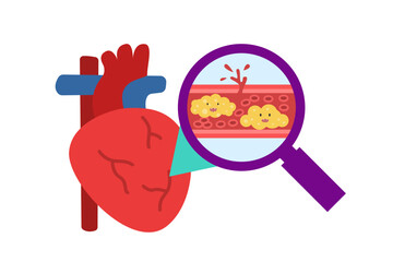 Cholesterol Buildup in Blood Vessel